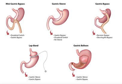 Revision Bariatric Surgery.png
